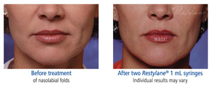 Restylane Results