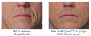 Restylane Results