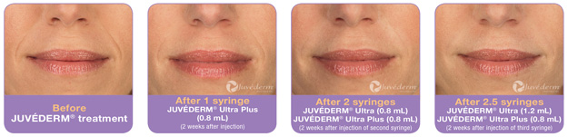 Juvederm Results